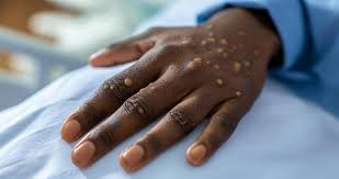 Monkeypox in Ghana: What You Need to Know